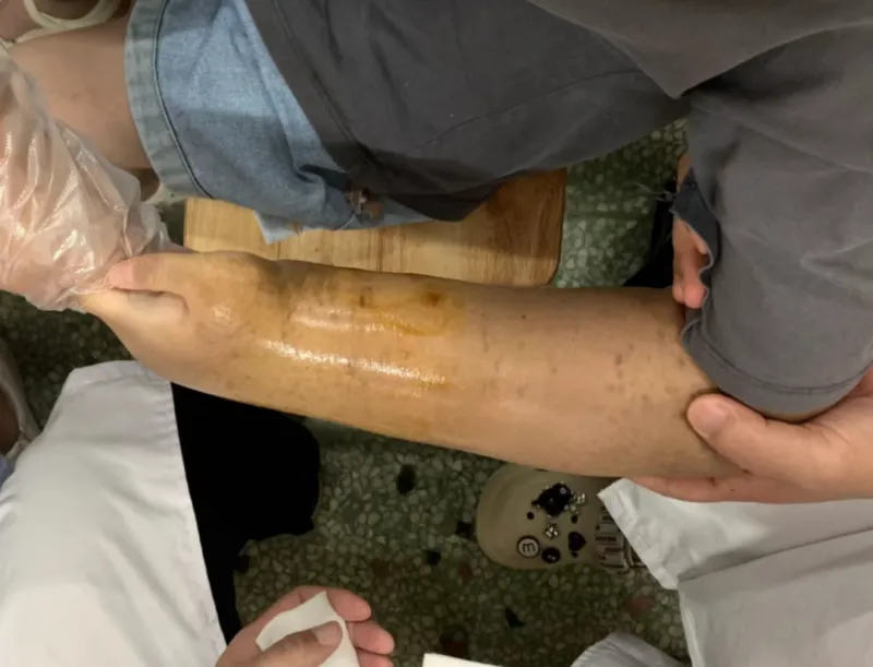 【卓越医疗】小儿骨折莫惊慌,中医正骨来帮忙 【卓越医疗】小儿骨折莫惊慌,中医正骨来帮忙