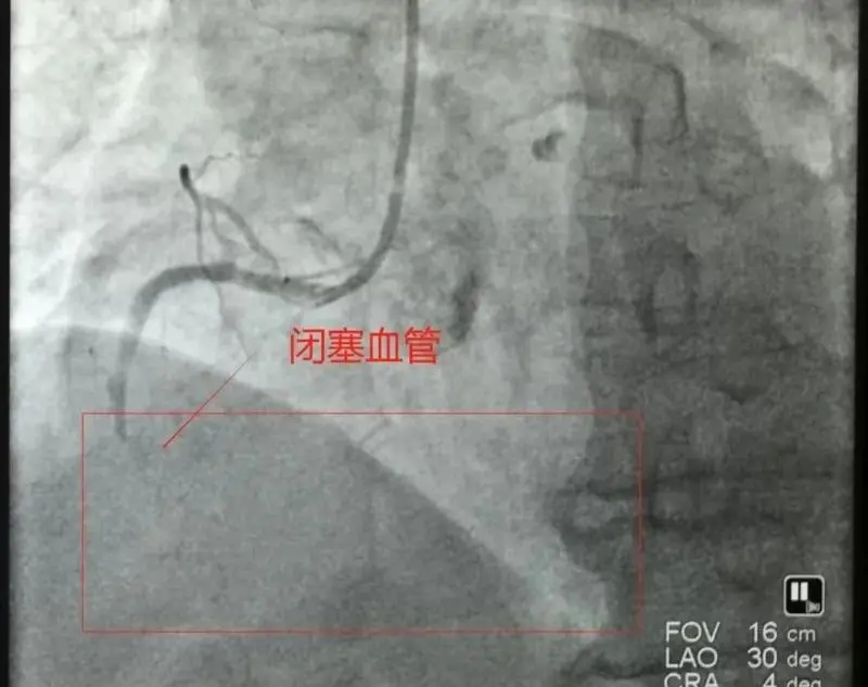【卓越医疗】仅14分钟,我院胸痛中心团队与时间赛跑,再刷心梗抢救速度 【卓越医疗】仅14分钟,我院胸痛中心团队与时间赛跑,再刷心梗抢救速度