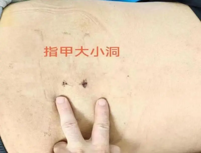 走不动、走不远?UBE微创技术,为腰椎管狭窄患者重塑行走之路 走不动、走不远?UBE微创技术,为腰椎管狭窄患者重塑行走之路