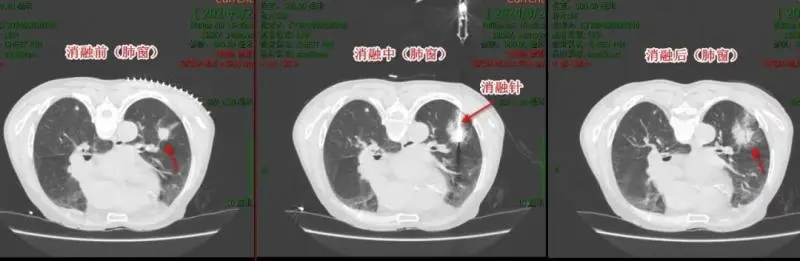【中心医院·医者红】“热死”癌细胞，这个技术牛！
