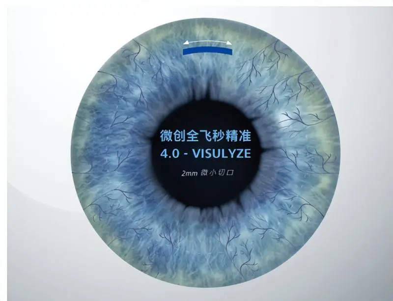 全面升级!湘潭爱尔仁和医院正式引入微创全飞秒精准4.0-VISULYZE技术 全面升级!湘潭爱尔仁和医院正式引入微创全飞秒精准4.0-VISULYZE技术