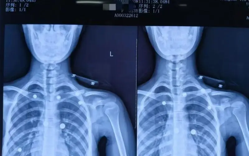 【卓越医疗】锁骨骨折不开刀 中医正骨有妙招