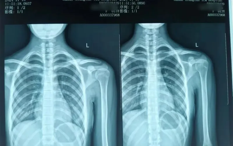 【卓越医疗】锁骨骨折不开刀 中医正骨有妙招