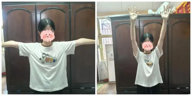 【卓越医疗】锁骨骨折不开刀 中医正骨有妙招