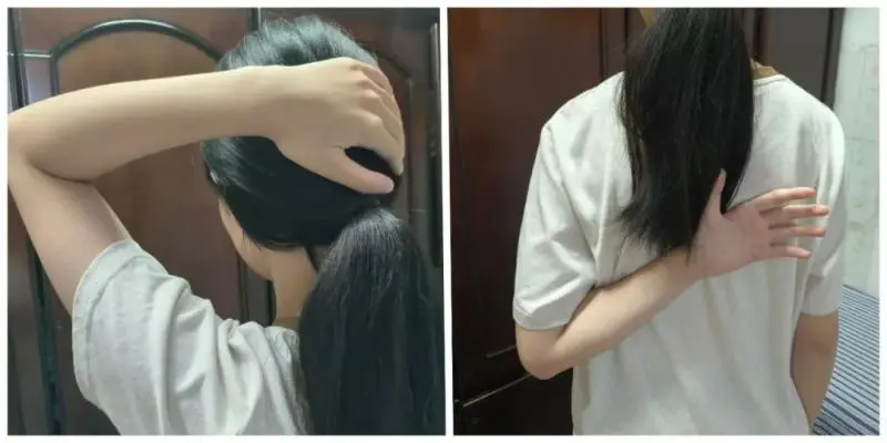 【卓越医疗】锁骨骨折不开刀 中医正骨有妙招