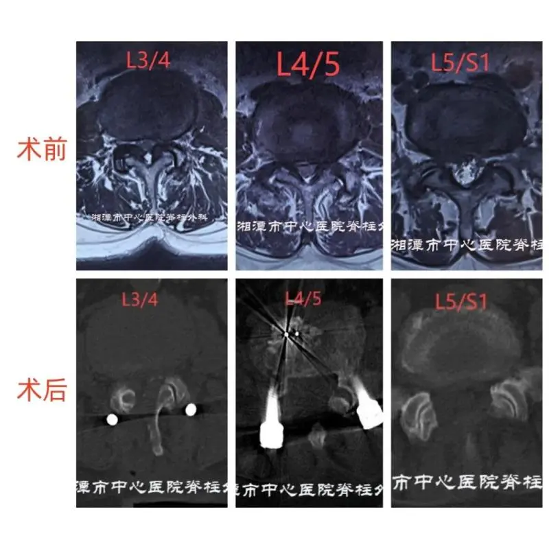 【中心医院·医者红】站着痛,坐着麻!老腰“作妖”几时休? 【中心医院·医者红】站着痛,坐着麻!老腰“作妖”几时休?