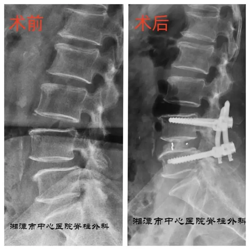 【中心医院·医者红】站着痛,坐着麻!老腰“作妖”几时休? 【中心医院·医者红】站着痛,坐着麻!老腰“作妖”几时休?