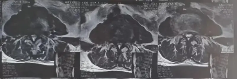 【中心医院·医者红】跨千里医疗援疆路:单侧双通道内镜手术解患者腰疾之困 【中心医院·医者红】跨千里医疗援疆路:单侧双通道内镜手术解患者腰疾之困