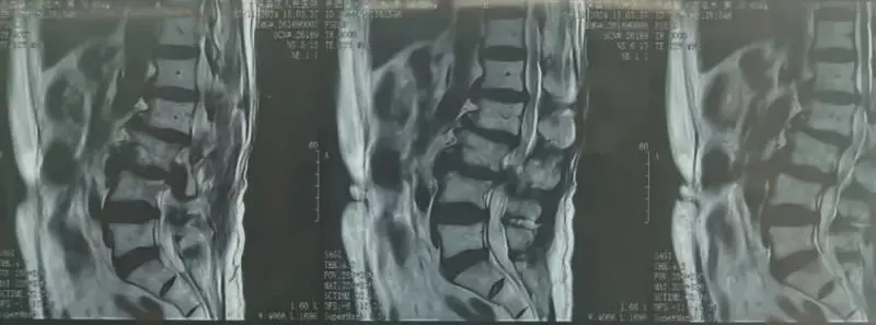 【中心医院·医者红】跨千里医疗援疆路:单侧双通道内镜手术解患者腰疾之困 【中心医院·医者红】跨千里医疗援疆路:单侧双通道内镜手术解患者腰疾之困