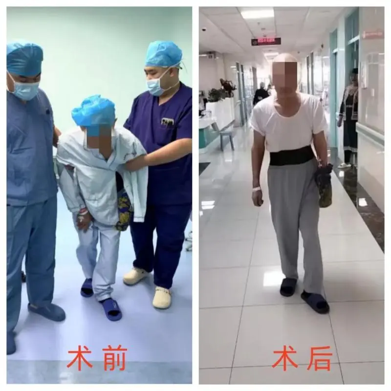 【中心医院·医者红】跨千里医疗援疆路:单侧双通道内镜手术解患者腰疾之困 【中心医院·医者红】跨千里医疗援疆路:单侧双通道内镜手术解患者腰疾之困