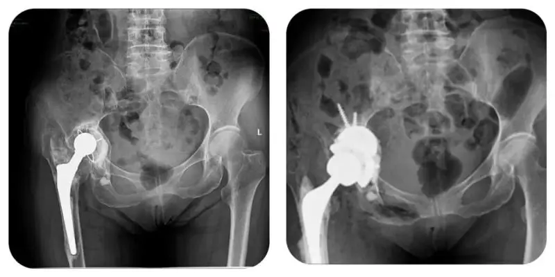 【中心医院·医者红】髋关节置换20年后两条腿长度相差5cm! 3D技术助力翻修“长短腿”! 【中心医院·医者红】髋关节置换20年后两条腿长度相差5cm! 3D技术助力翻修“长短腿”!