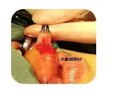 新技术突破:舌黏膜“移花接木”,“跨界”尿道修复 新技术突破:舌黏膜“移花接木”,“跨界”尿道修复