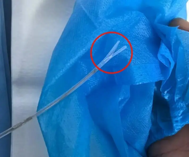 15岁男孩吞下3片美工刀片!胃镜“蓬蓬裙”秒变救命神器 15岁男孩吞下3片美工刀片!胃镜“蓬蓬裙”秒变救命神器