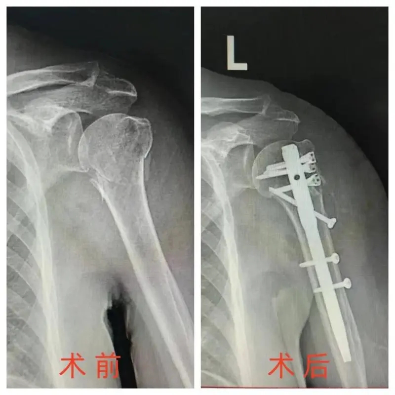 【中心医院·医者红】Multilock髓内钉：肱骨近段骨折治疗的微创利器