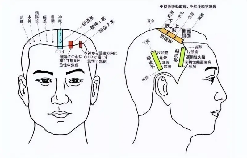 头针疗法助睡眠—— 湘潭市中医医院针灸科为您守护健康睡眠 头针疗法助睡眠—— 湘潭市中医医院针灸科为您守护健康睡眠