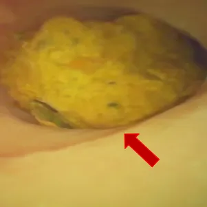 阑尾炎不用挨一刀?新技术让“保阑”成为可能! 阑尾炎不用挨一刀?新技术让“保阑”成为可能!