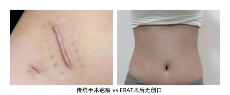 阑尾炎不用挨一刀?新技术让“保阑”成为可能! 阑尾炎不用挨一刀?新技术让“保阑”成为可能!