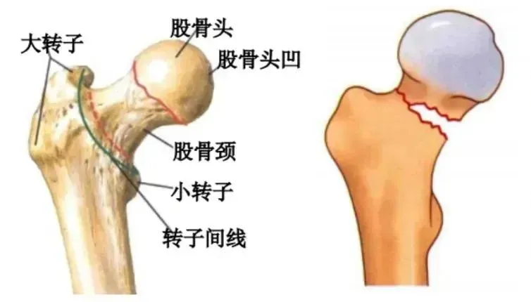 【中心医院·医者红】三天逆转“人生最后一次骨折” 【中心医院·医者红】三天逆转“人生最后一次骨折”