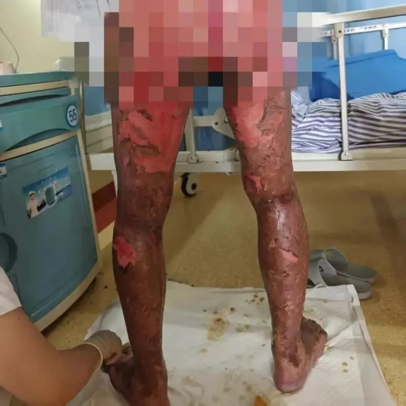 【大病不出市】57岁男子全身95%皮肤剥落！发病率百万分之七