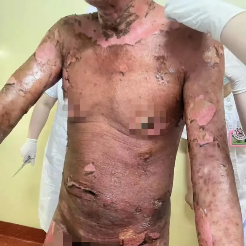 【大病不出市】57岁男子全身95%皮肤剥落！发病率百万分之七