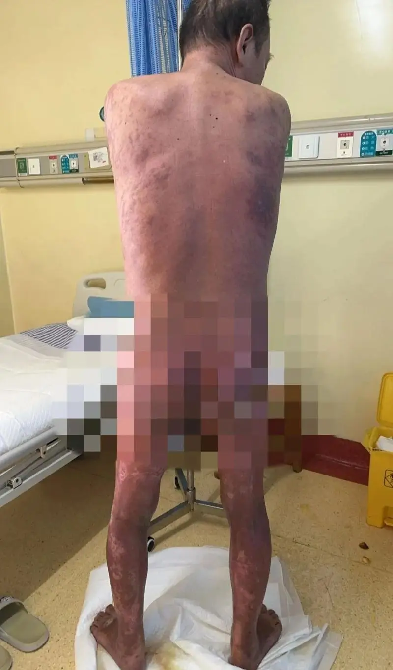 【大病不出市】57岁男子全身95%皮肤剥落！发病率百万分之七
