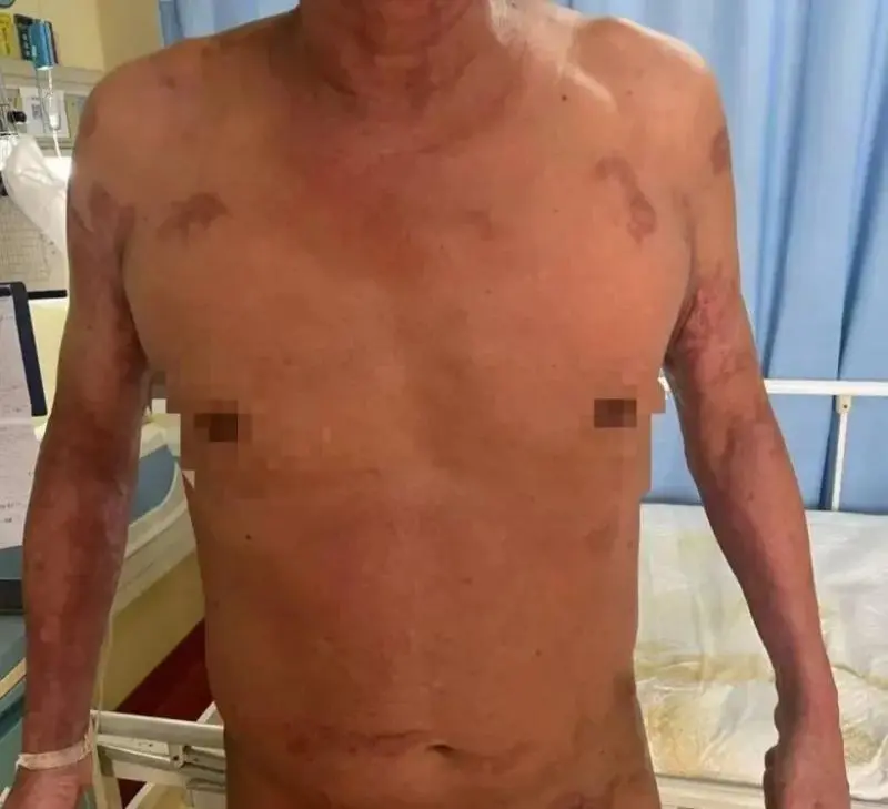 【大病不出市】57岁男子全身95%皮肤剥落！发病率百万分之七