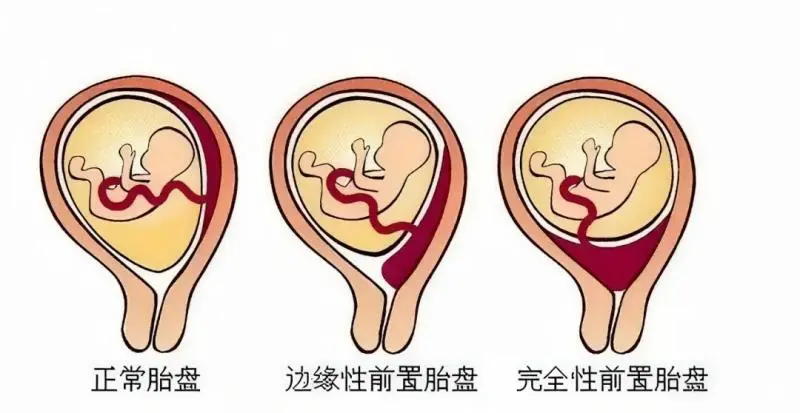 多学科联动,湘潭县妇幼成功守护高危孕产妇平安 多学科联动,湘潭县妇幼成功守护高危孕产妇平安