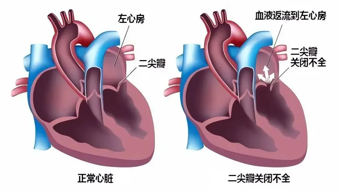 寻医记③丨怕“开胸”,忍了几年!医生从腿上“穿针引线”修复心门