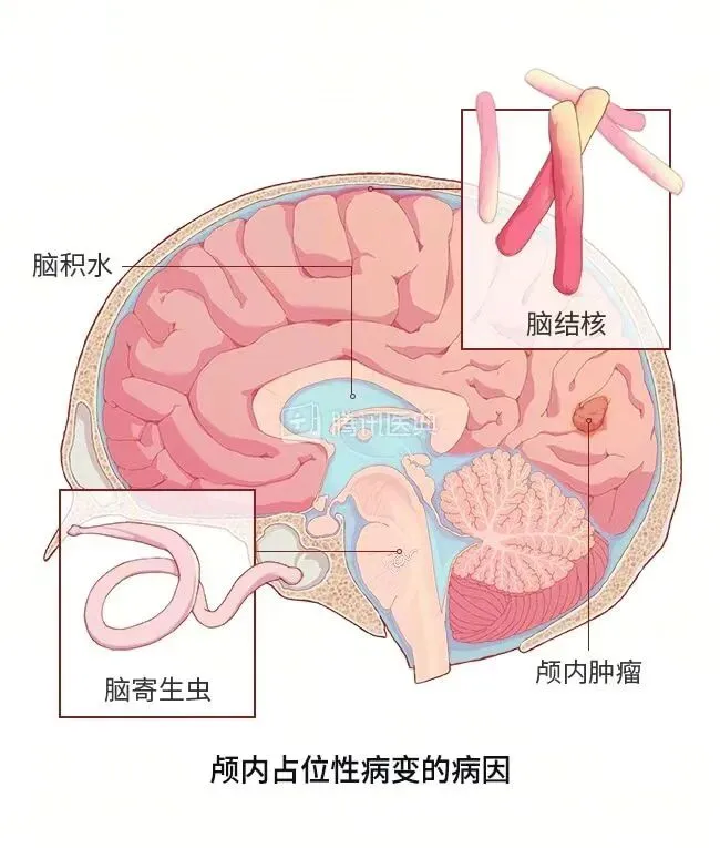 湘潭县人民医院颅脑/心胸外科成功完成一例复杂左颞叶占位病变切除术