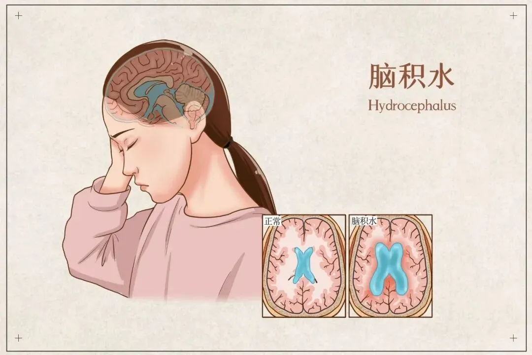 6个月“大头宝宝”跨城求医,刷新医院最低龄V-P分流纪录