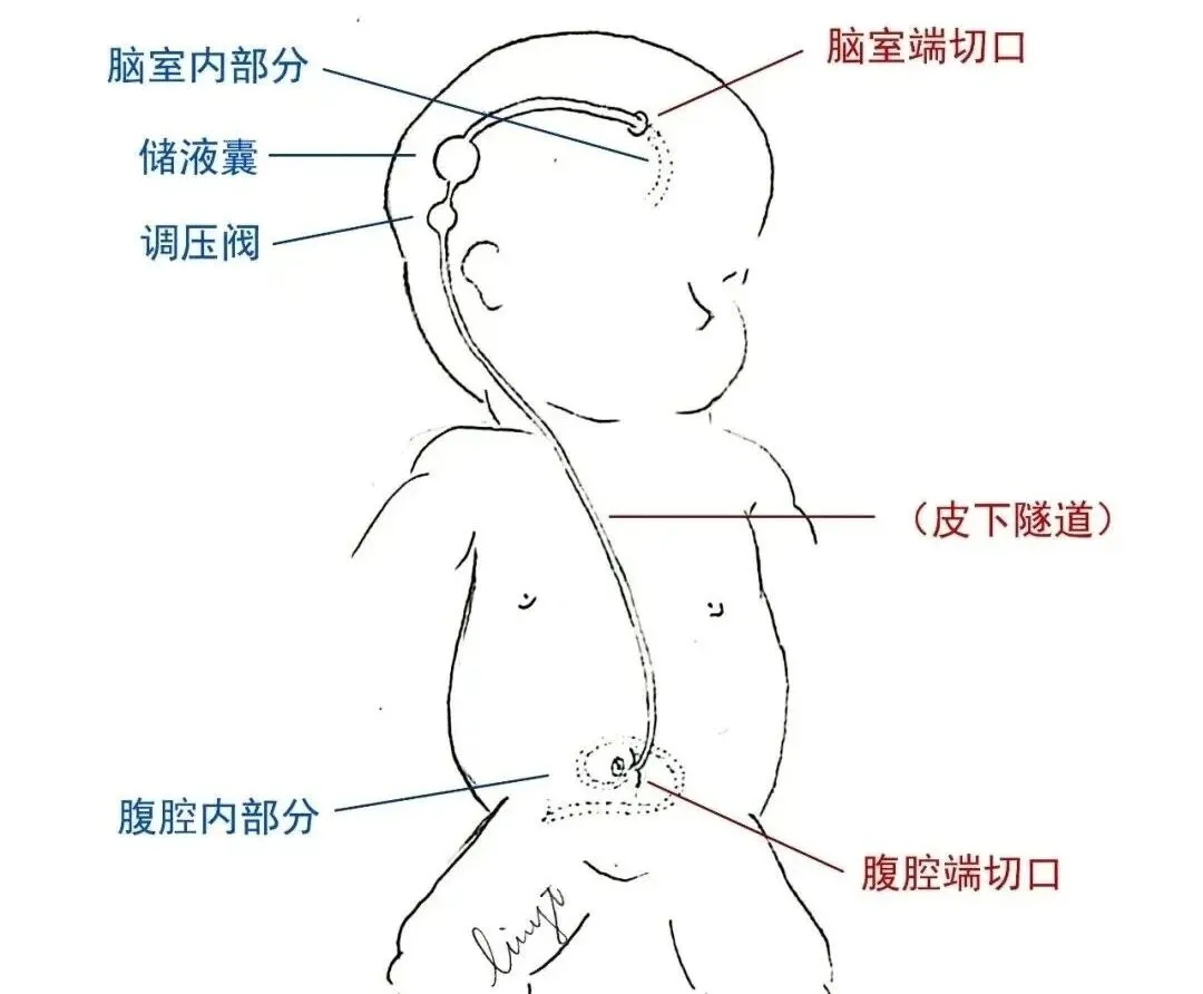 6个月“大头宝宝”跨城求医,刷新医院最低龄V-P分流纪录