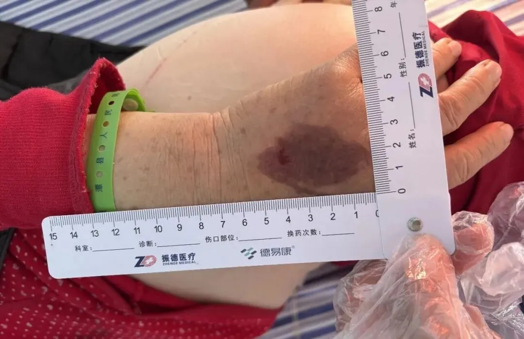 警惕!一氧化碳中毒不只是缺氧,还有烫伤冻伤等隐藏风险