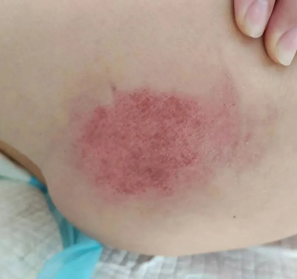 警惕!一氧化碳中毒不只是缺氧,还有烫伤冻伤等隐藏风险