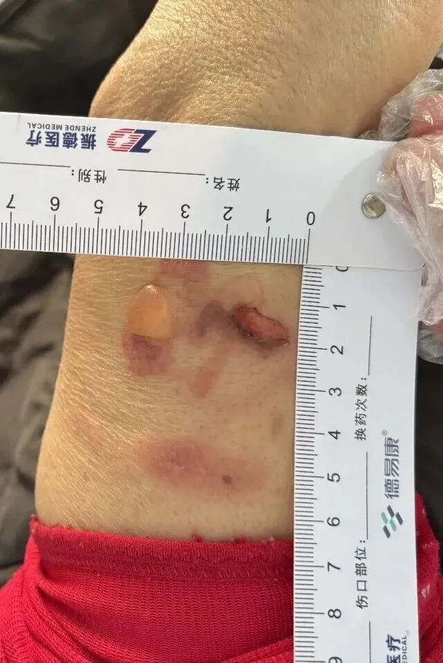 警惕!一氧化碳中毒不只是缺氧,还有烫伤冻伤等隐藏风险