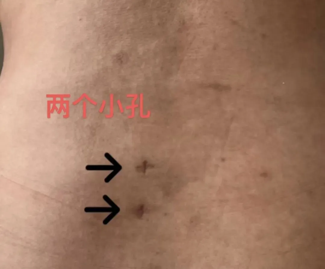 腰椎间盘突出坐卧不宁,“两个小孔”精准解除苦痛