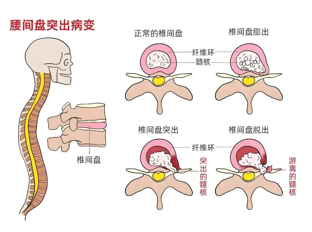 腰椎间盘突出坐卧不宁,“两个小孔”精准解除苦痛