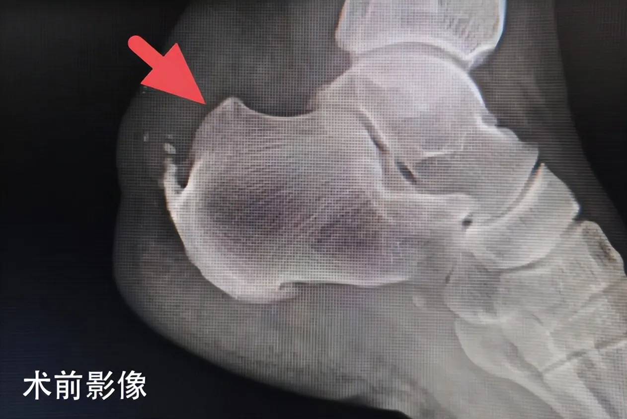 在家门口享省级诊疗！湘潭市中医医院成功开展复杂Haglund畸形精准重塑手术
