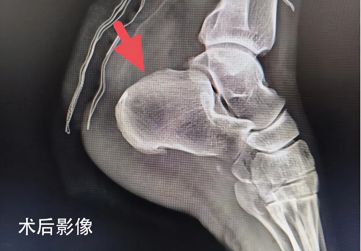 在家门口享省级诊疗！湘潭市中医医院成功开展复杂Haglund畸形精准重塑手术