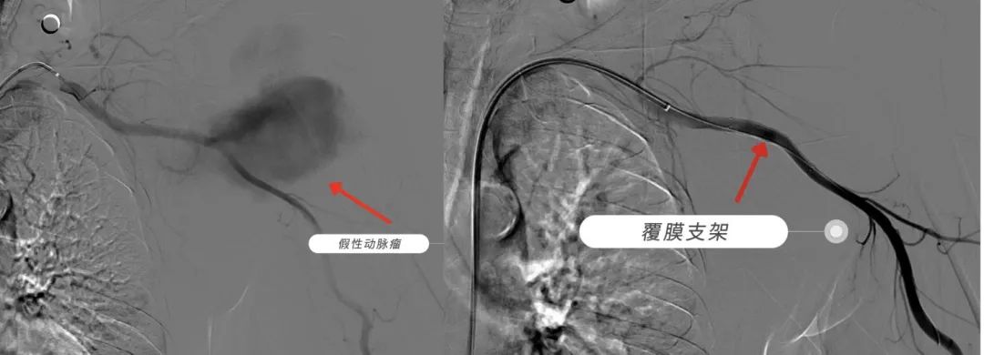 “架”到病除:不开刀也能修补大血管,这处隐匿风险被成功化解