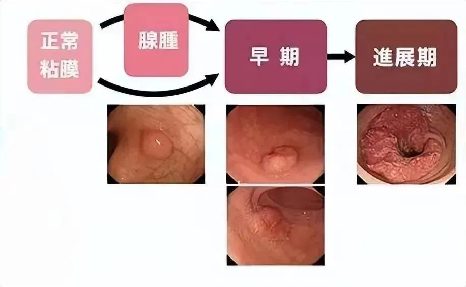 息肉切了也要查，防癌才能真到家