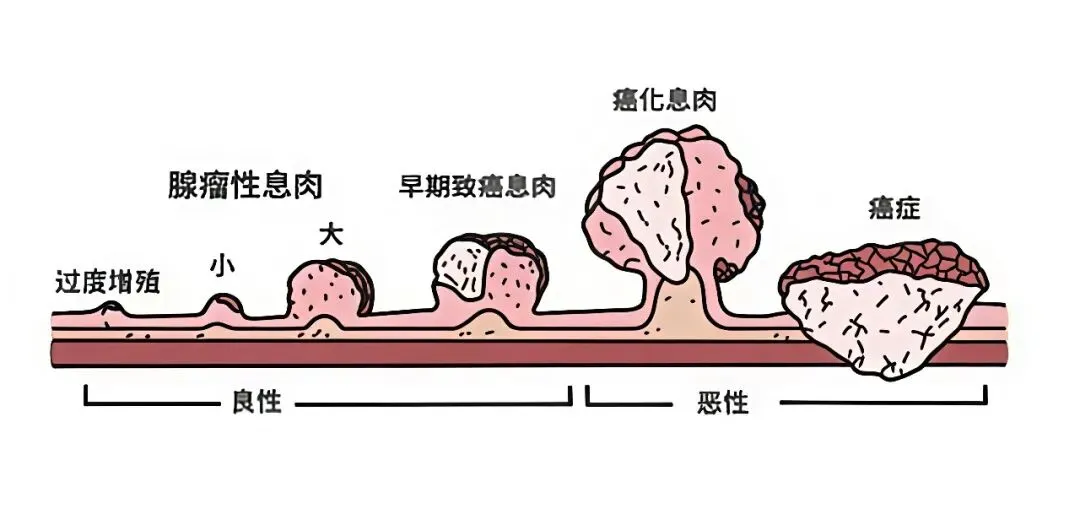 息肉切了也要查，防癌才能真到家