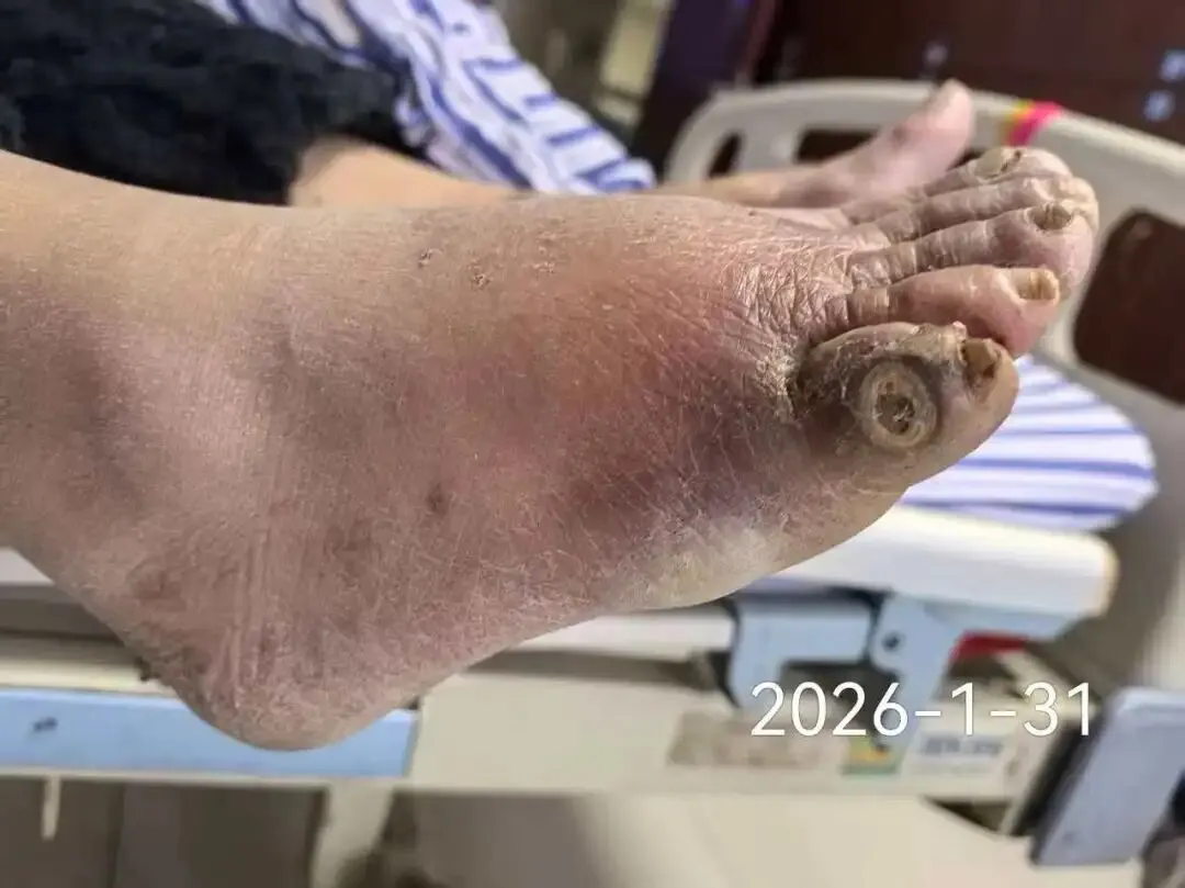 足部溃疡久治不愈?我院专科治愈两例重症糖足感染