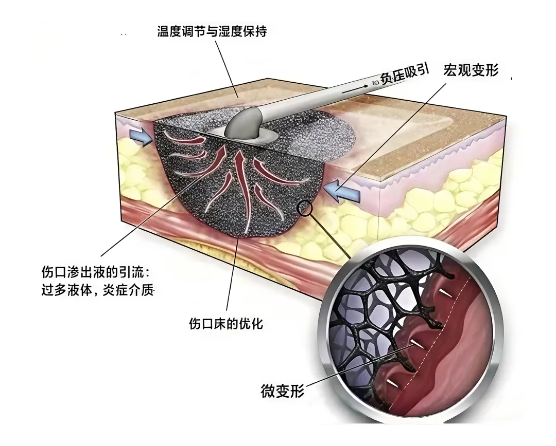 足部溃疡久治不愈?我院专科治愈两例重症糖足感染