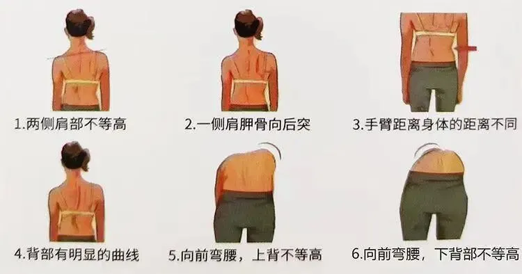 亲眼见证脊背蜕变!双胞胎历经三年规范脊柱康复,高考志愿双双填报康复专业