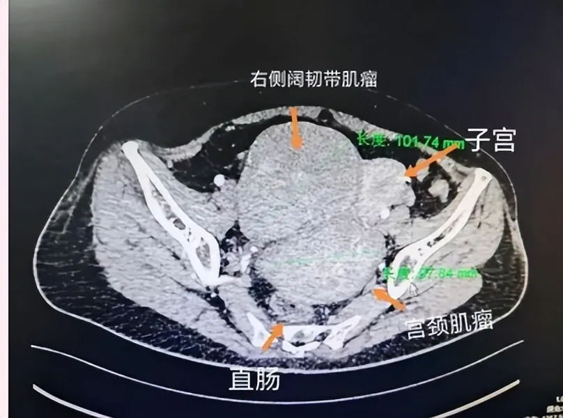 巨型复合子宫肌瘤困扰患者,我院妇产科团队微创一站式解除病痛