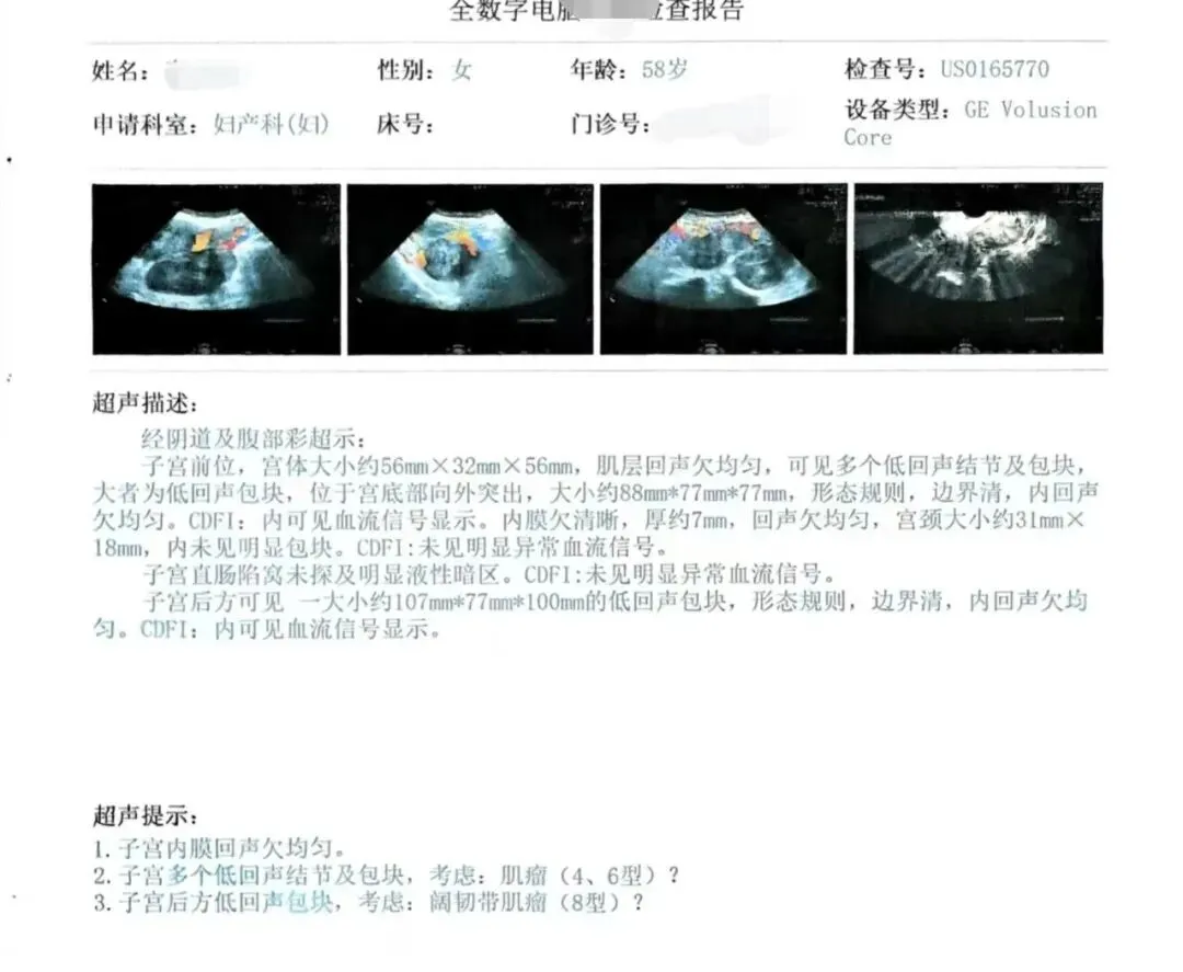 巨型复合子宫肌瘤困扰患者,我院妇产科团队微创一站式解除病痛