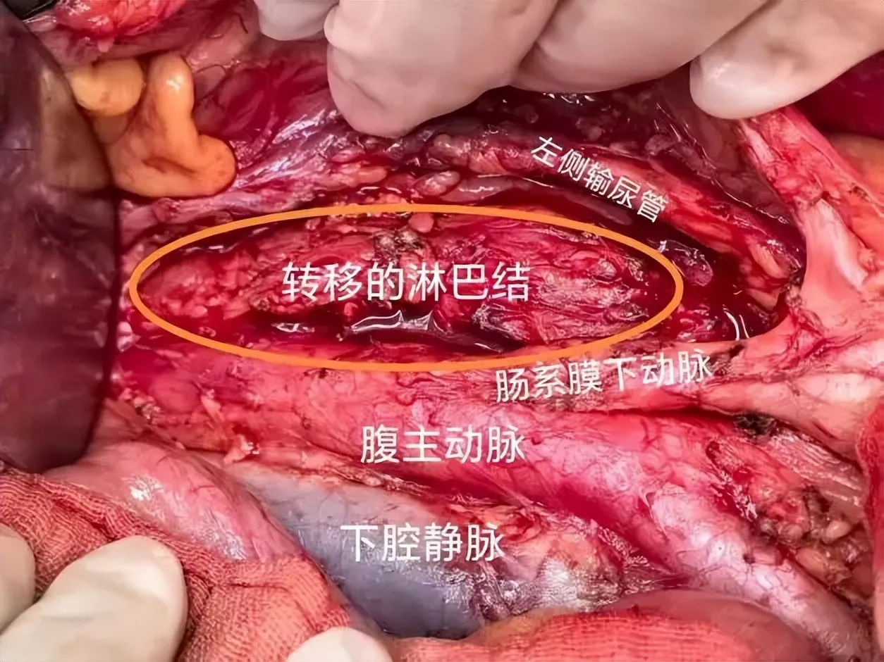 警惕妇科“沉默杀手”-卵巢癌!