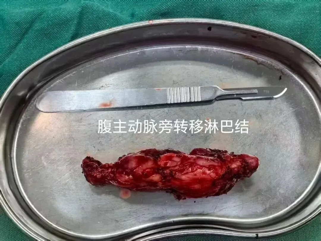 警惕妇科“沉默杀手”-卵巢癌!