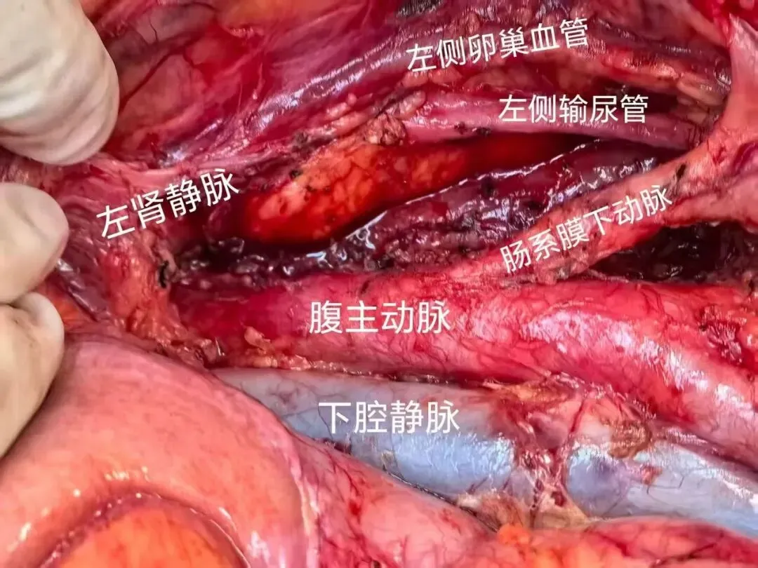 警惕妇科“沉默杀手”-卵巢癌!
