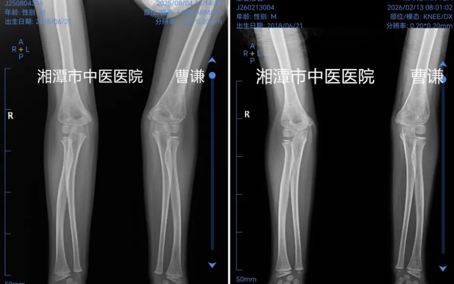跨越千里的信任，中医正骨让肘外翻患儿重获健康